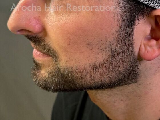 Facial Hair Transplantation: Case 14 - After