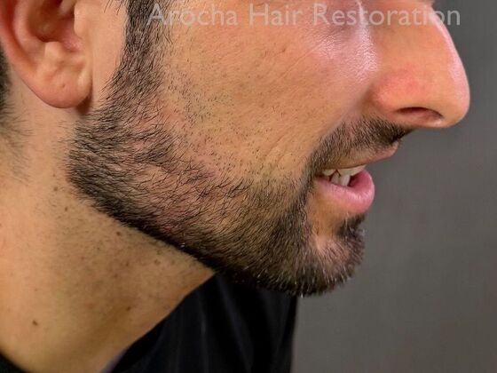Facial Hair Transplantation: Case 14 - After