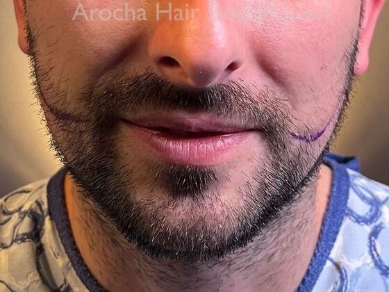 Facial Hair Transplantation Case 14 - Before