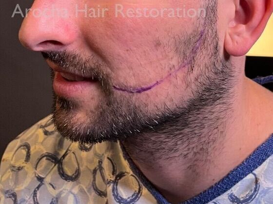 Facial Hair Transplantation: Case 14 - Before