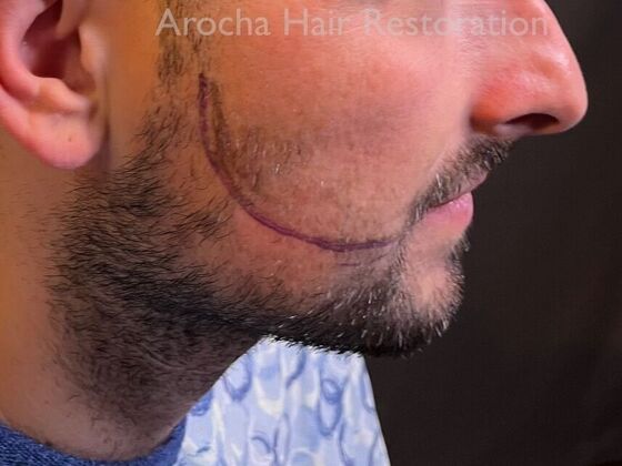 Facial Hair Transplantation: Case 14 - Before