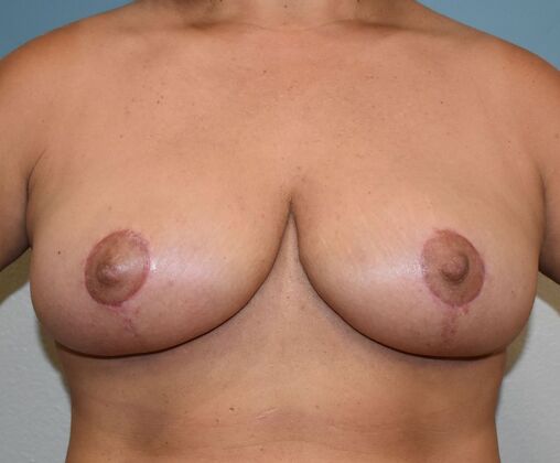 Breast Lift (Mastopexy) Case 195 - After