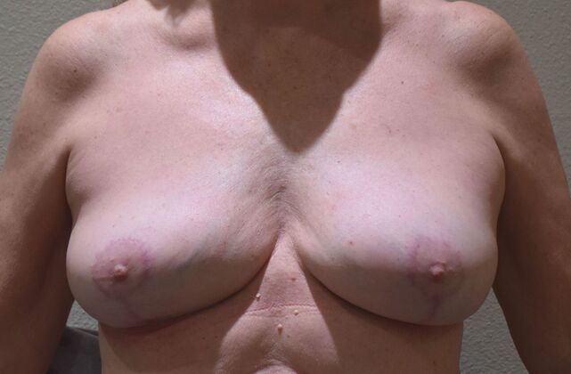 Breast Implant Removal: Case 37 - After