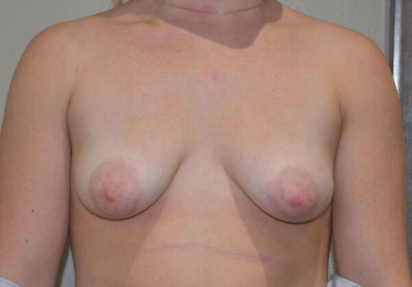 Breast Augmentation Case 755 - Before