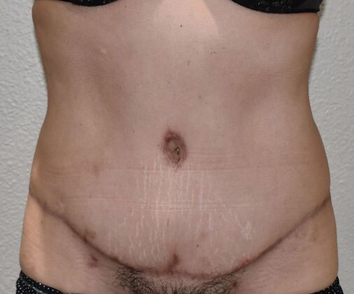 Tummy Tuck (Abdominoplasty): Case 467 - After