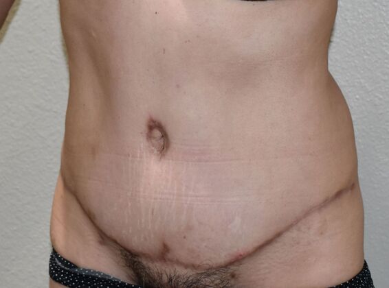 Tummy Tuck (Abdominoplasty): Case 467 - After