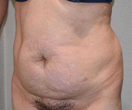 Tummy Tuck (Abdominoplasty): Case 467 - Before