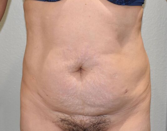 Tummy Tuck (Abdominoplasty): Case 467 - Before
