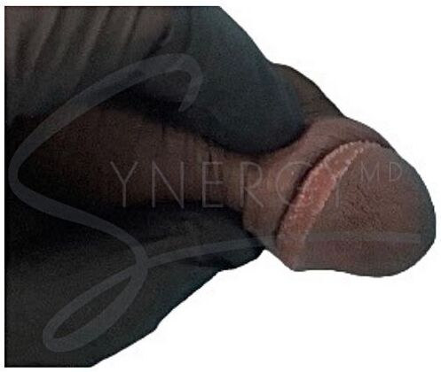 Pearly Penile Papule (PPP) Case 1 - Before