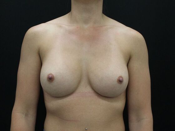 Breast Augmentation Case 99 - After