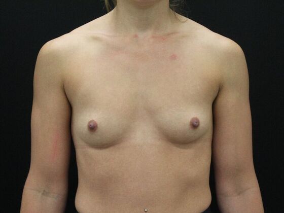 Breast Augmentation Case 99 - Before