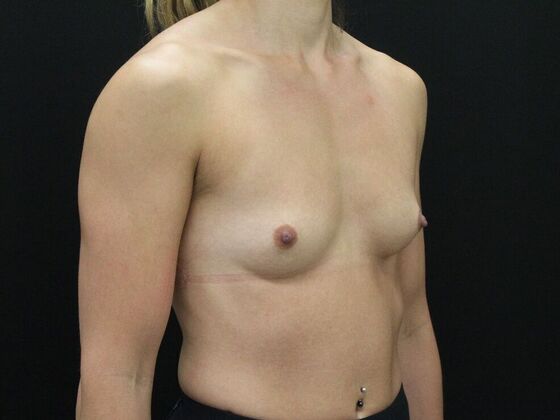 Breast Augmentation: Case 99 - Before