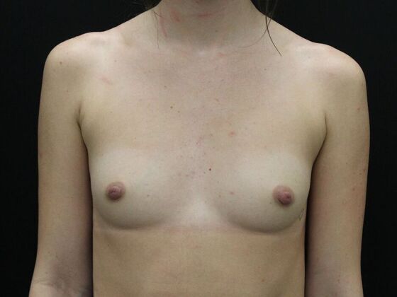 Breast Augmentation: Case 101 - Before