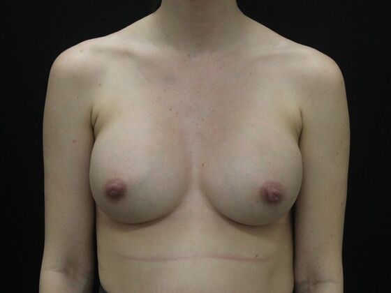 Breast Augmentation: Case 101 - After