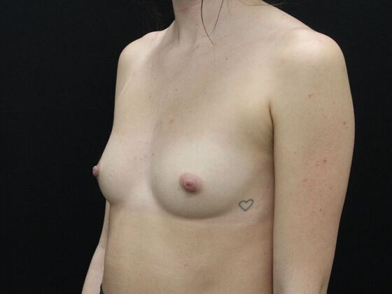 Breast Augmentation: Case 101 - Before