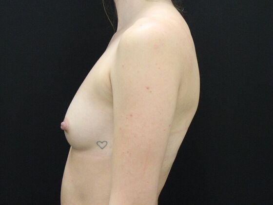 Breast Augmentation: Case 101 - Before