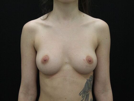 Breast Augmentation: Case 102 - Before