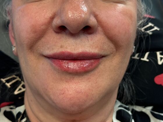 Cosmetic Injectables & Fillers*: Case 59 Lip Filler - After