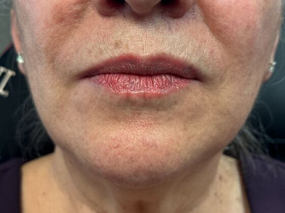 Cosmetic Injectables & Fillers*: Case 59 Lip Filler - Before