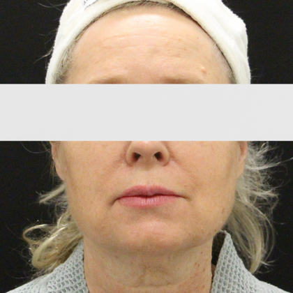 Face & Neck Lifts: Case 2 - Before