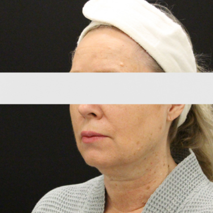 Face & Neck Lifts: Case 2 - Before