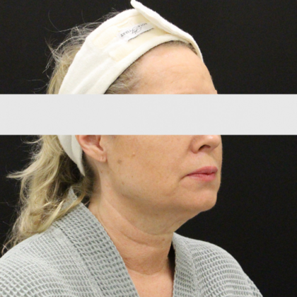 Face & Neck Lifts: Case 2 - Before