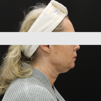 Face & Neck Lifts: Case 2 - Before
