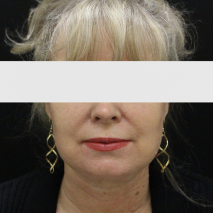 Face & Neck Lifts: Case 2 - After