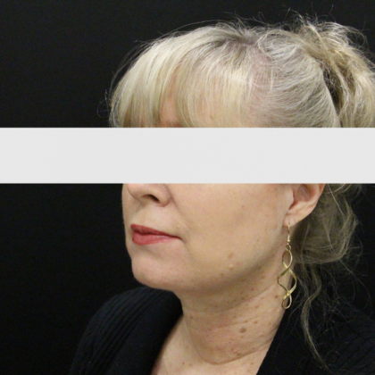 Face & Neck Lifts: Case 2 - After
