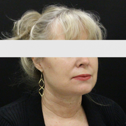Face & Neck Lifts: Case 2 - After