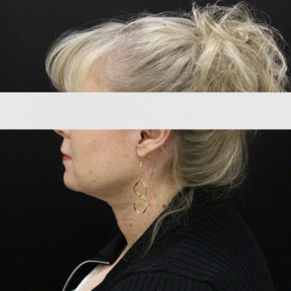 Face & Neck Lifts Case 2 - After