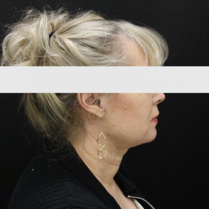 Face & Neck Lifts: Case 2 - After