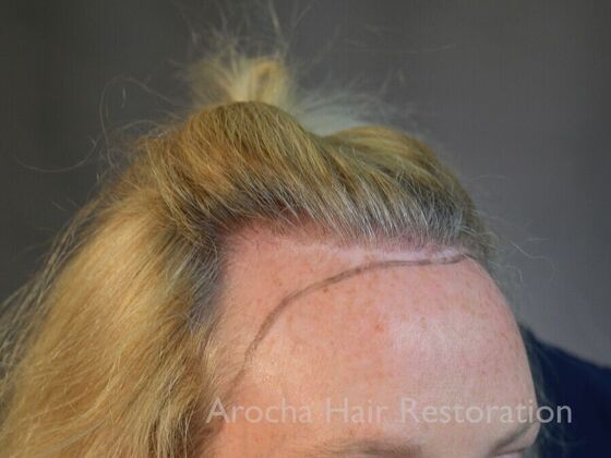 Hairline Feminization: Case 1 - Before