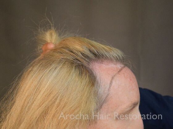 Hairline Feminization: Case 1 - Before