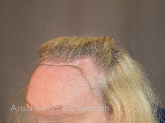 Hairline Feminization: Case 1 - Before