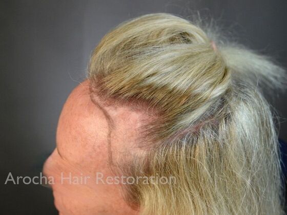 Hairline Feminization: Case 1 - Before