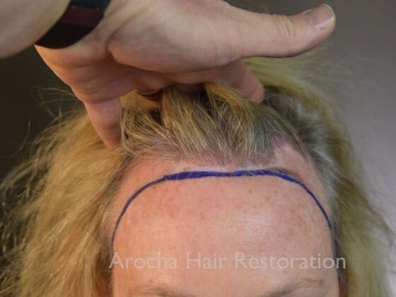 Hairline Feminization: Case 1 - Before