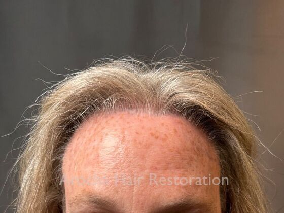 Hairline Feminization: Case 1 - After