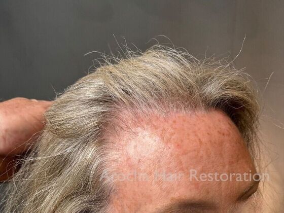 Hairline Feminization: Case 1 - After