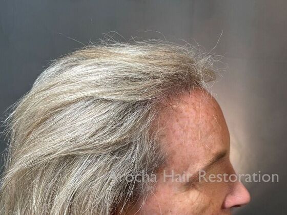 Hairline Feminization: Case 1 - After