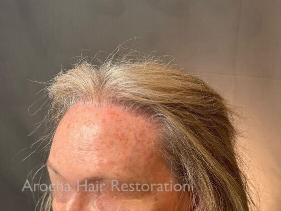 Hairline Feminization: Case 1 - After