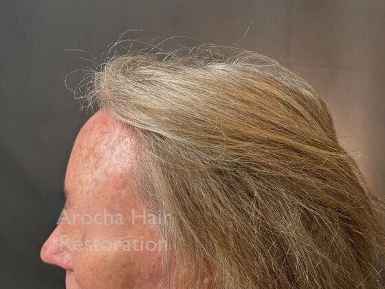 Hairline Feminization: Case 1 - After