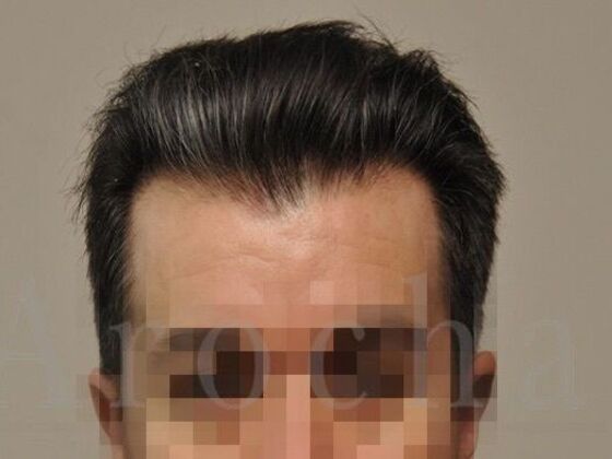 FUT Hair Restoration Case 39 - After