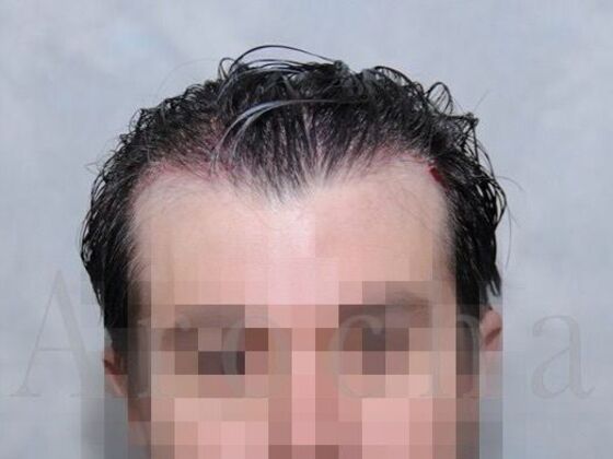 FUT Hair Restoration Case 39 - Before