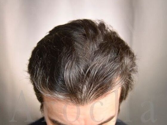 FUT Hair Restoration: Case 39 - After