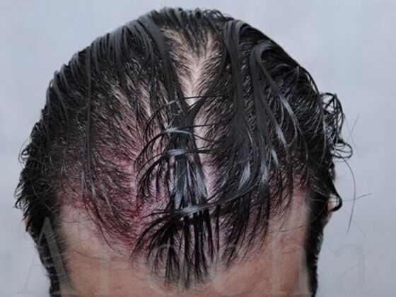 FUT Hair Restoration: Case 39 - Immediately post-op