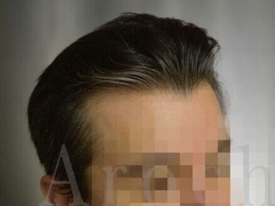 FUT Hair Restoration: Case 39 - After