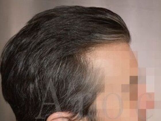 FUT Hair Restoration: Case 39 - After