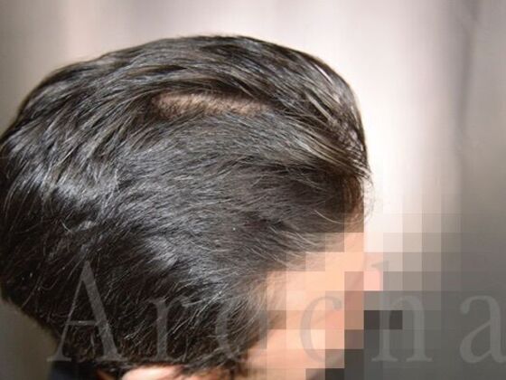 FUT Hair Restoration: Case 39 - After