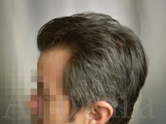 FUT Hair Restoration: Case 39 - After